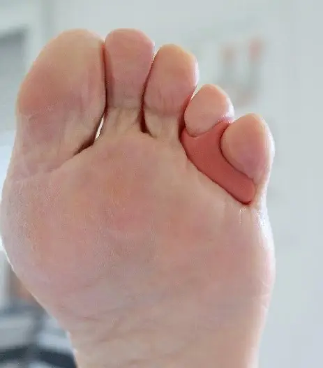 ortesi in silicone - trattamenti per alluce valgo, dita a martello non invasive - Centro Podologico Nardo