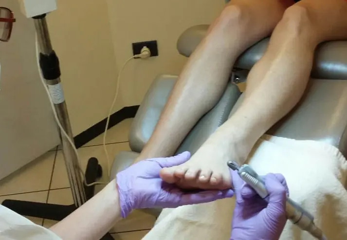 trattamenti podologici - podologo nardo - rimozione verruche e calli - Venezia