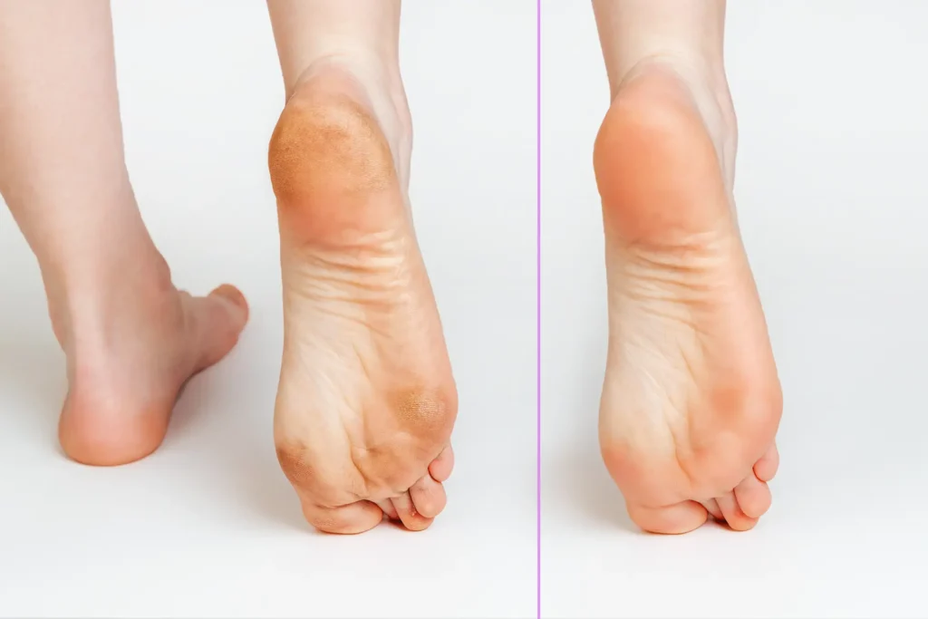 ipercheratosi - trattamento calli piede - podologo nardo venezia