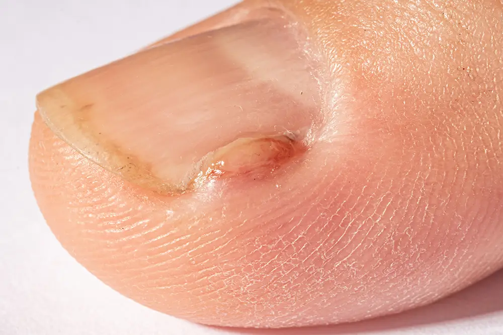 onicocriptosi - podologo per unghia incarnita - cause e cura - venezia