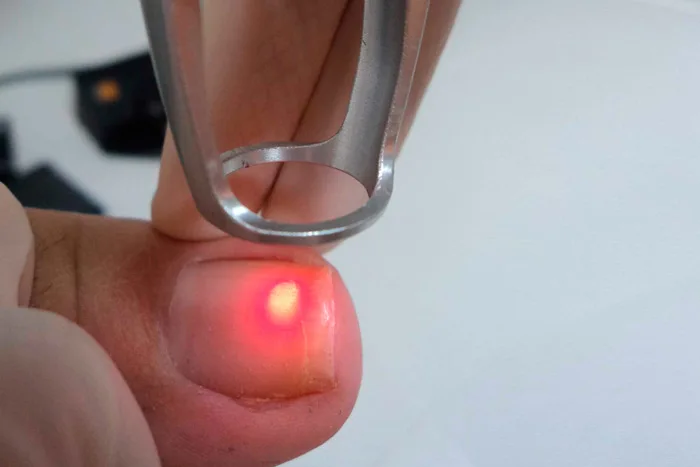 onicomicosi - cura delle unghie con laser terapia - podologo nardo