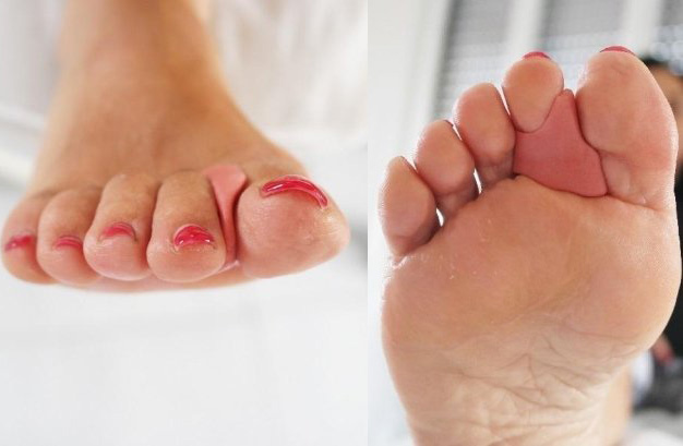 ortesi podologiche in silicone - centro podologico venezia - nardo